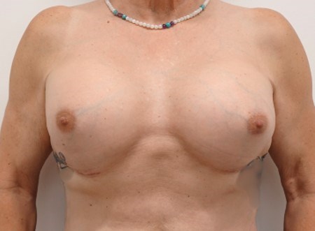 Breast Augmentation After