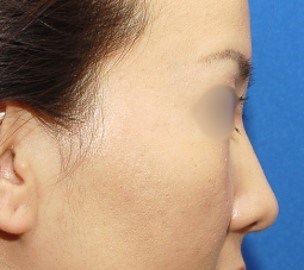Rhinoplasty Surgery Before