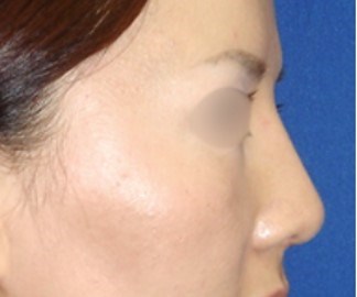 Rhinoplasty Surgery After