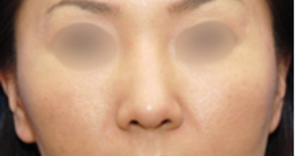 Rhinoplasty Surgery Before