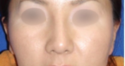 Rhinoplasty Surgery After