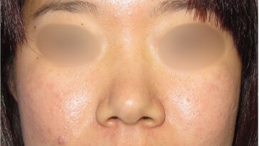 Rhinoplasty Surgery Before