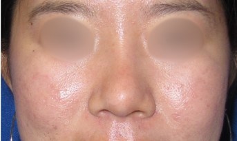 Rhinoplasty Surgery After