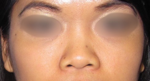 Rhinoplasty Surgery Before