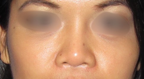 Rhinoplasty Surgery After