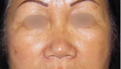 Rhinoplasty Surgery Before