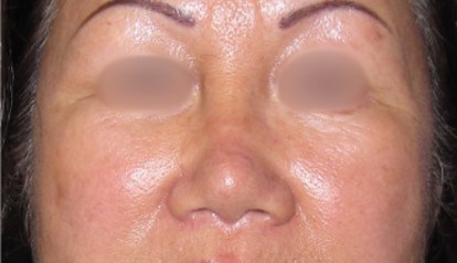 Rhinoplasty Surgery After