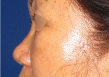 Rhinoplasty Surgery Before