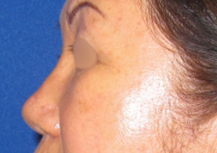 Rhinoplasty Surgery After