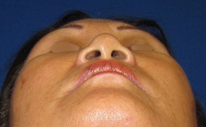 Rhinoplasty Surgery Before