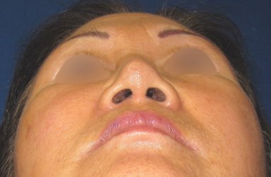 Rhinoplasty Surgery After