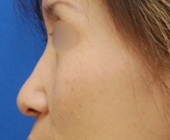 Rhinoplasty Surgery Before