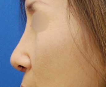 Rhinoplasty Surgery After
