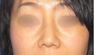 Rhinoplasty Surgery After