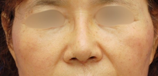 Rhinoplasty Surgery After