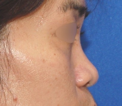 Rhinoplasty Surgery Before