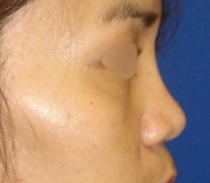 Rhinoplasty Surgery After
