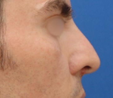 Rhinoplasty Surgery Before