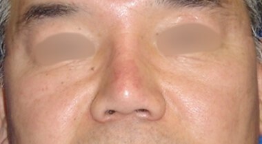 Rhinoplasty Surgery After