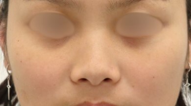 Rhinoplasty Surgery Before