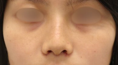 Rhinoplasty Surgery After