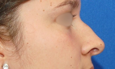 Rhinoplasty Surgery Before