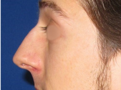 Rhinoplasty Surgery Before