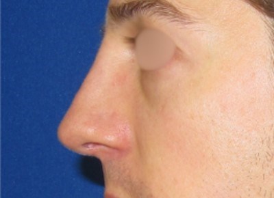 Rhinoplasty Surgery After