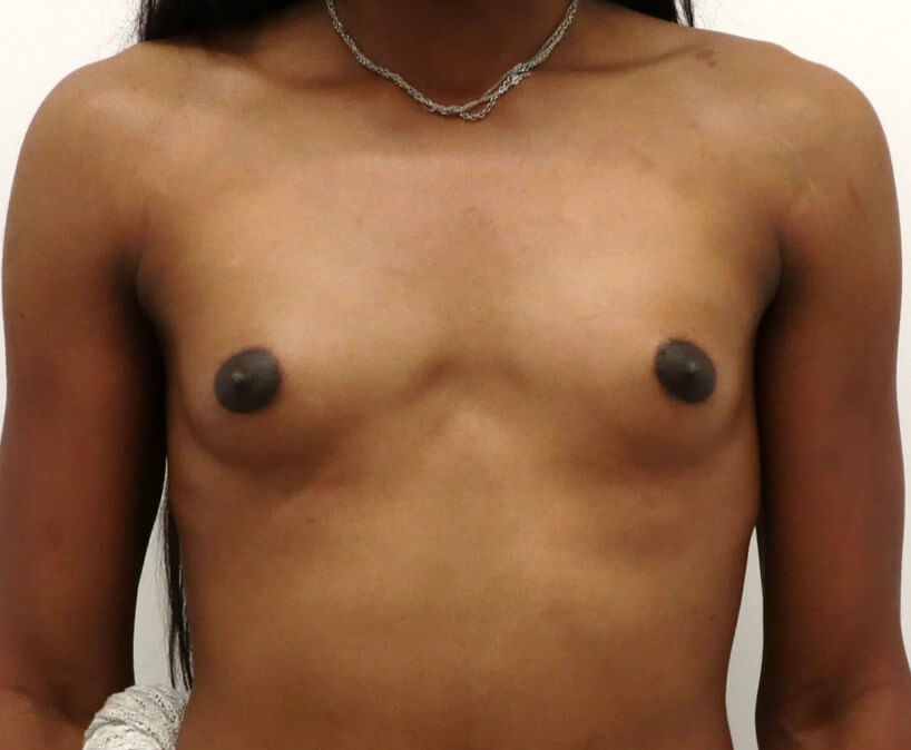 Breast Augmentation Before