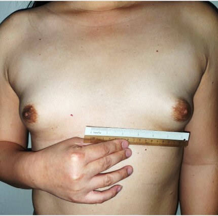 Breast Augmentation Before