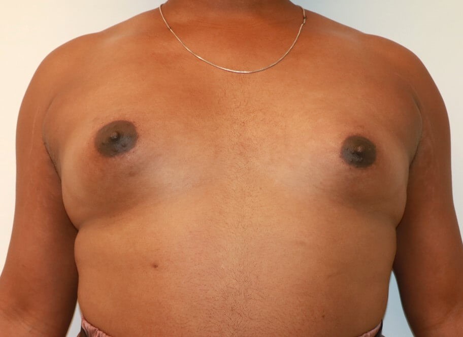 Breast Augmentation Before