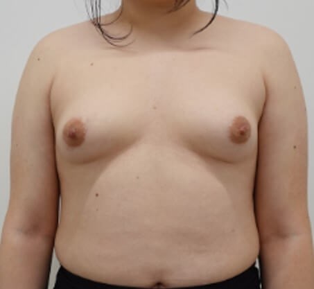 Breast Augmentation Before