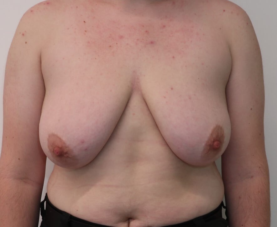 Mastectomy  Surgery Before