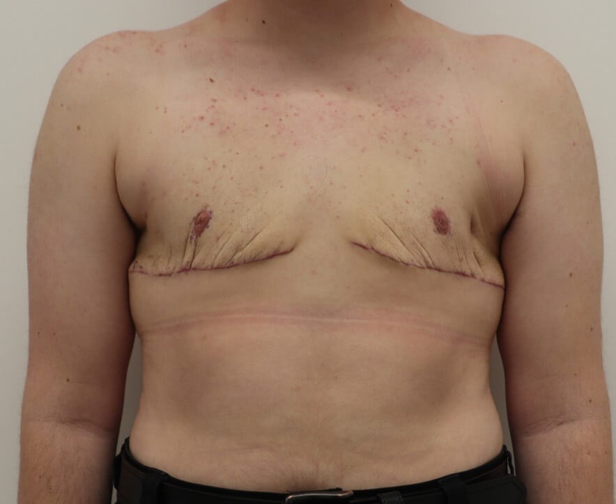 Mastectomy  Surgery After