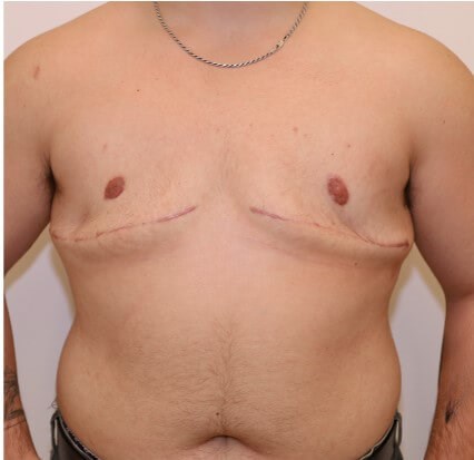 Mastectomy  Surgery After