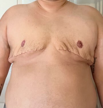 Mastectomy  Surgery After
