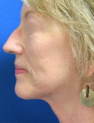 Facelift Surgery After