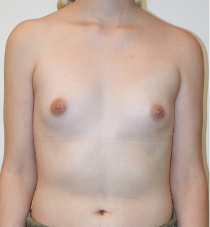 Breast Augmentation Before