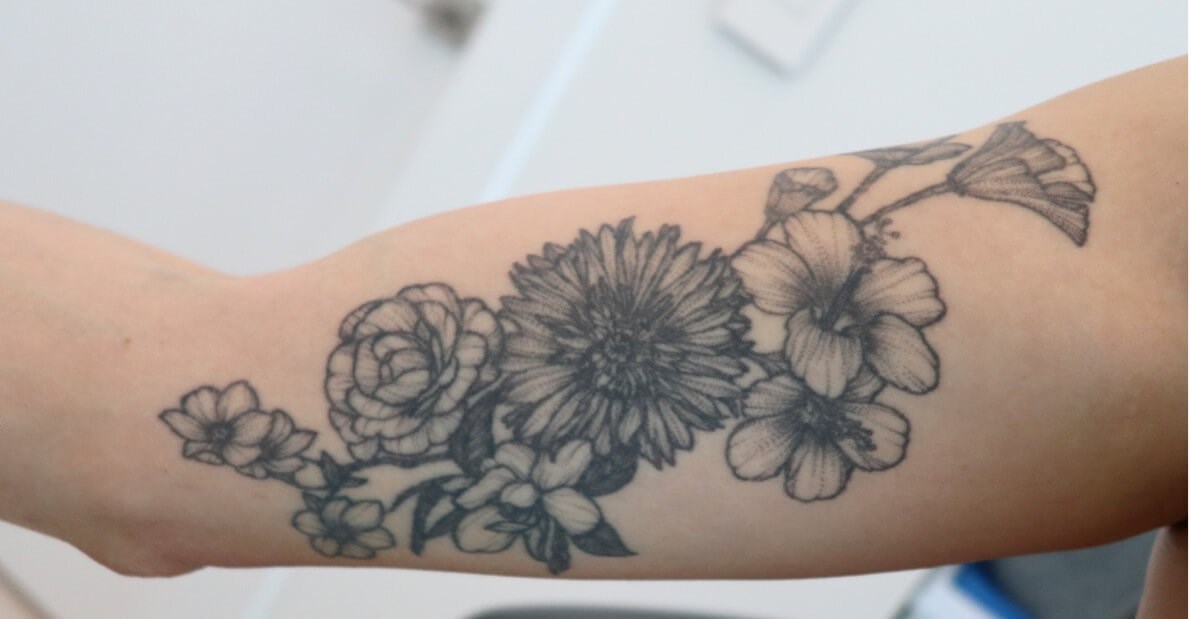 Laser Tattoo Removal Before