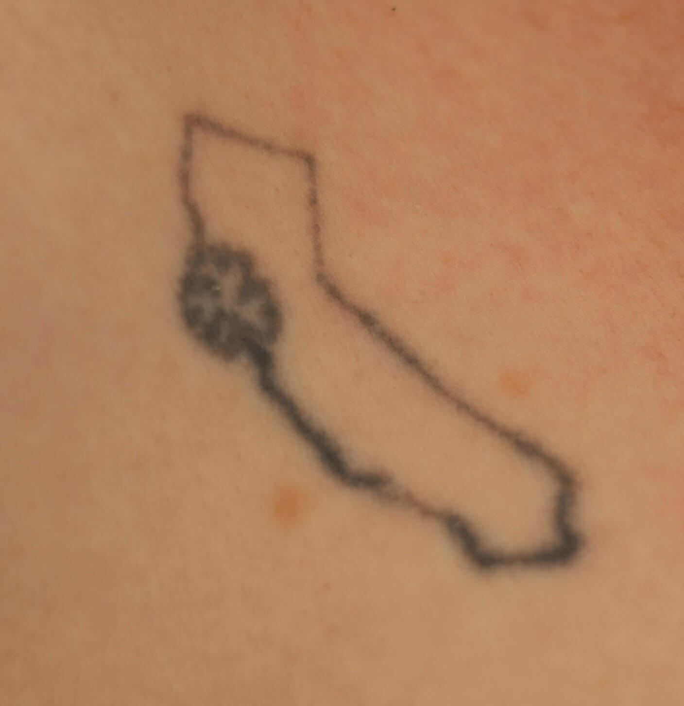 Laser Tattoo Removal Before