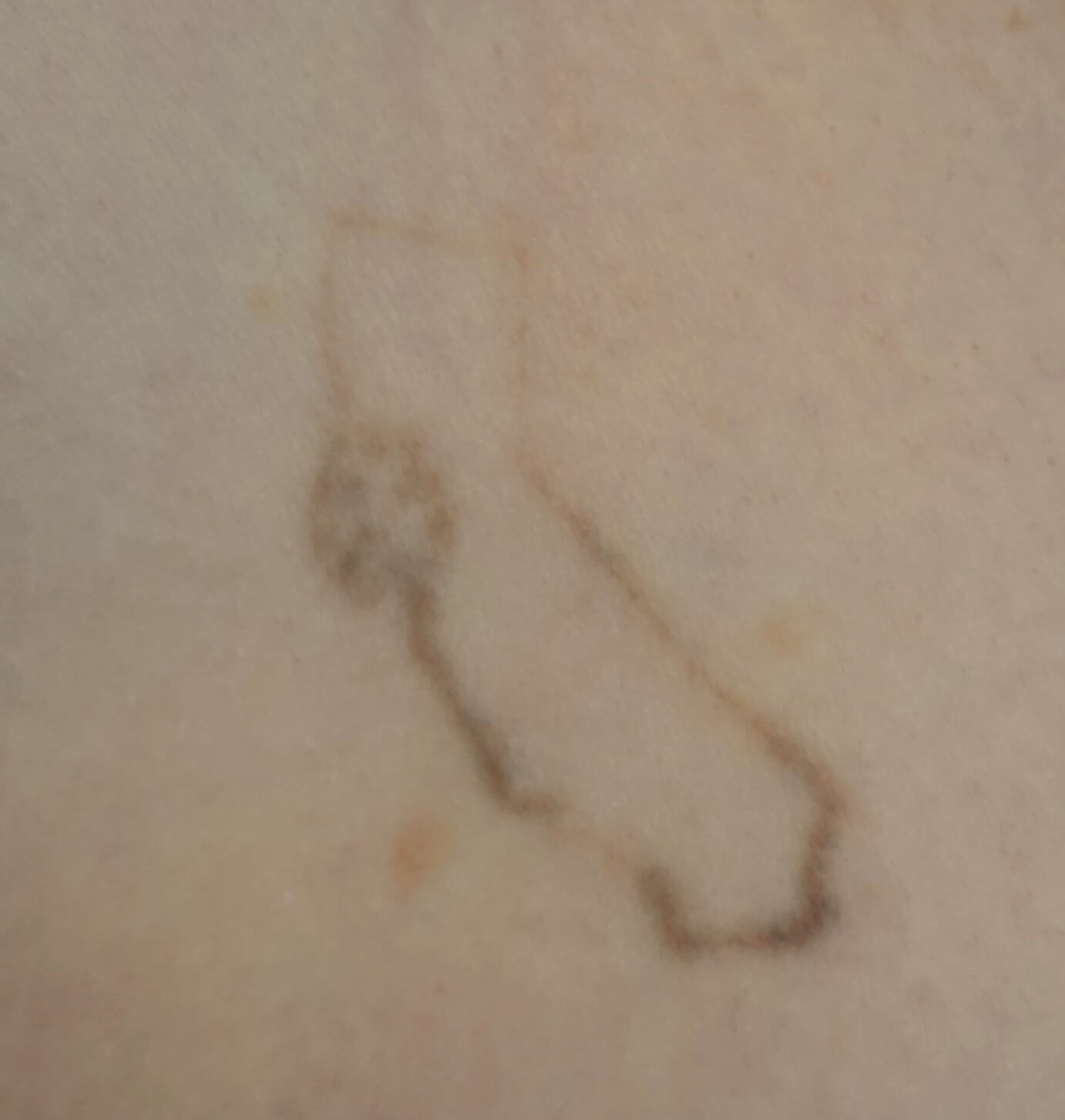 Laser Tattoo Removal After