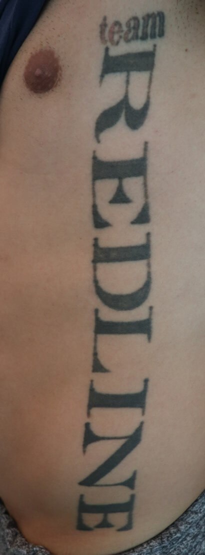 Laser Tattoo Removal Before