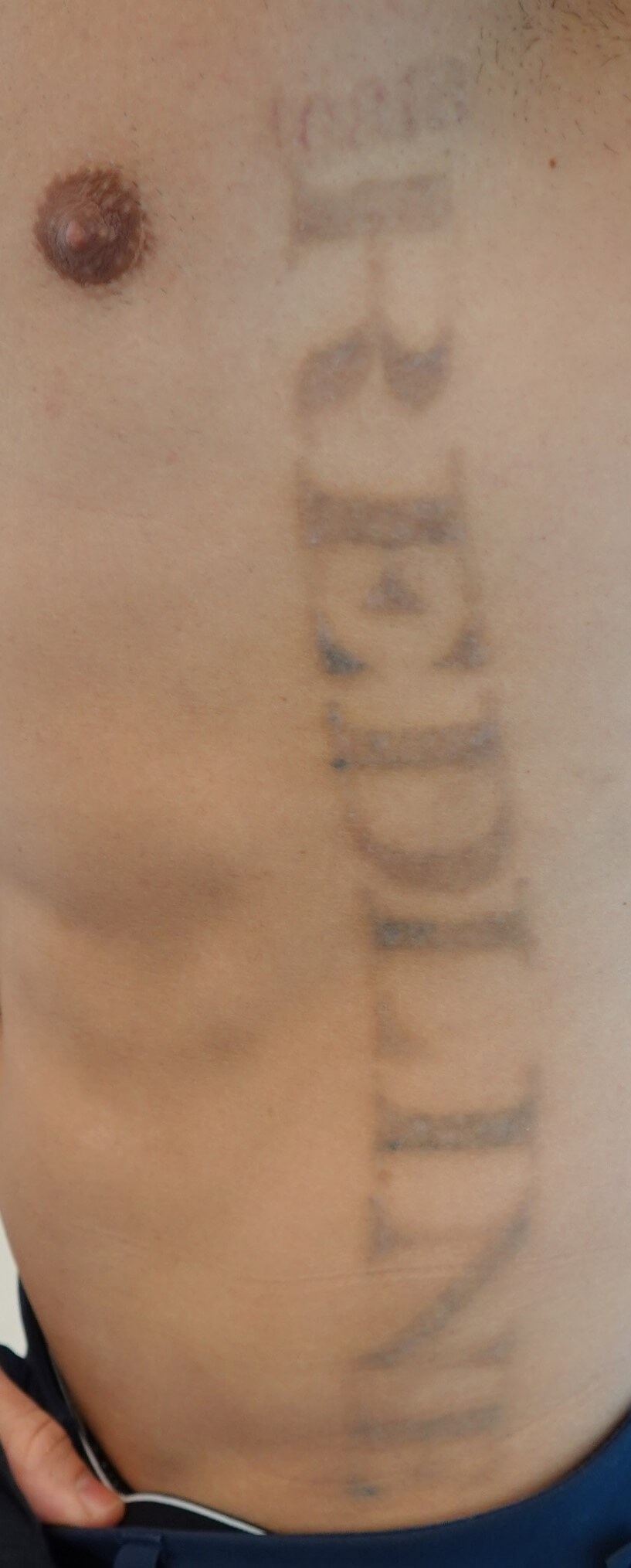 Laser Tattoo Removal After
