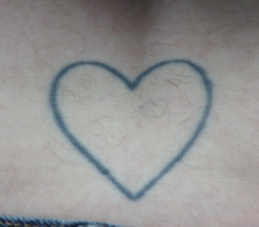 Laser Tattoo Removal Before