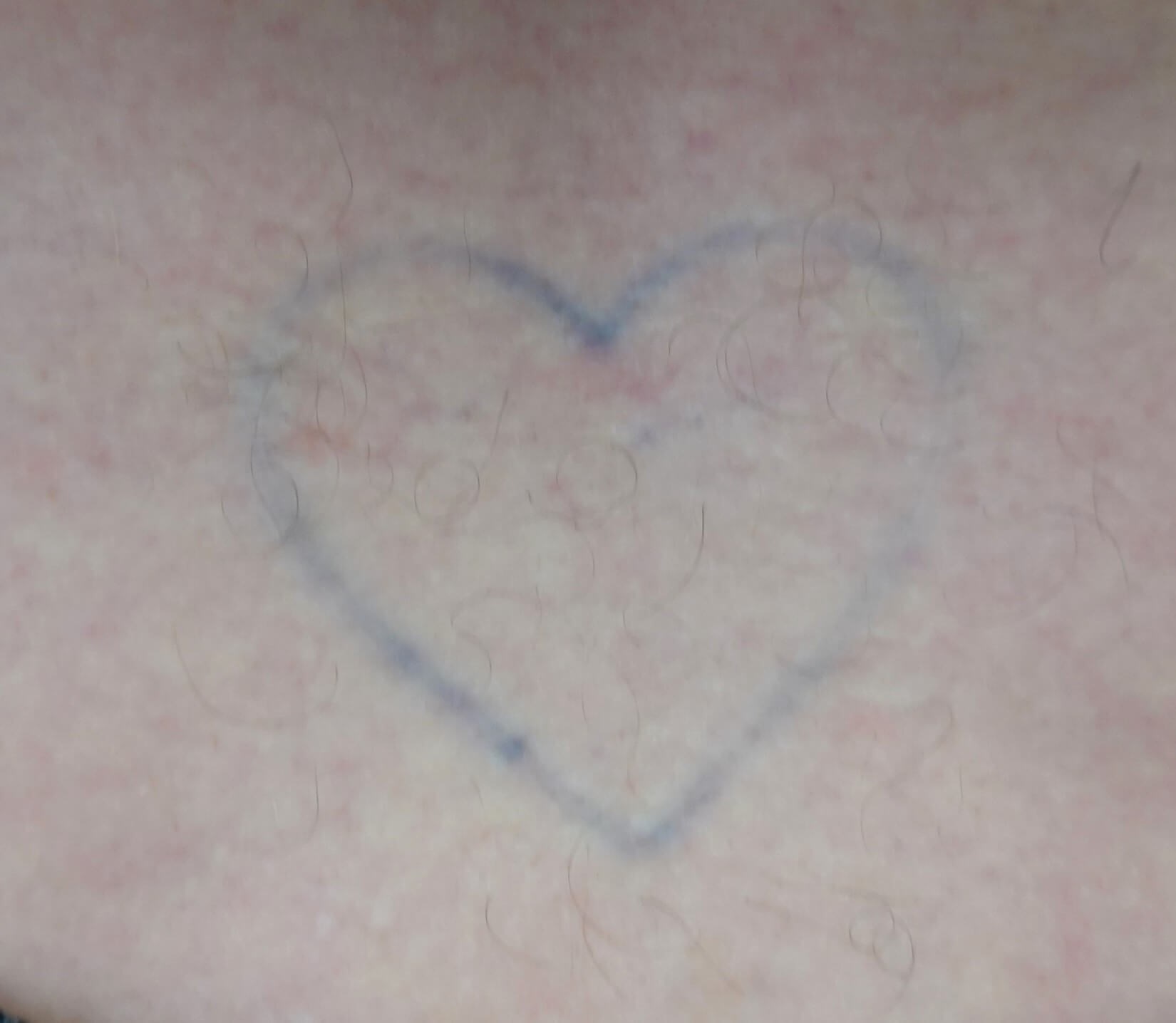 Laser Tattoo Removal After