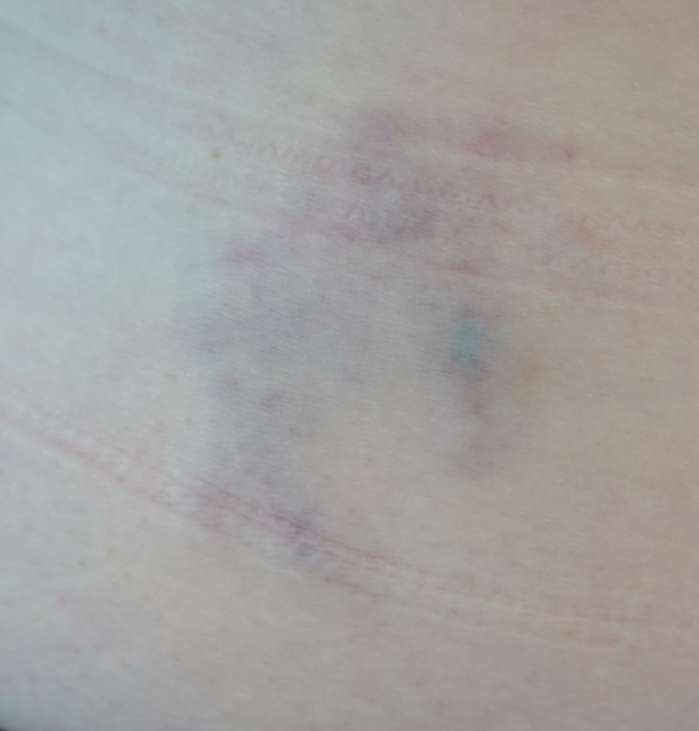 Laser Tattoo Removal After
