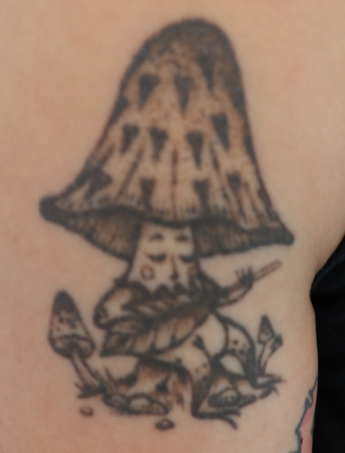 Laser Tattoo Removal Before