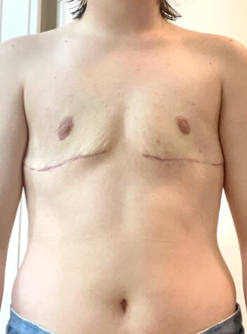 Mastectomy Surgery After