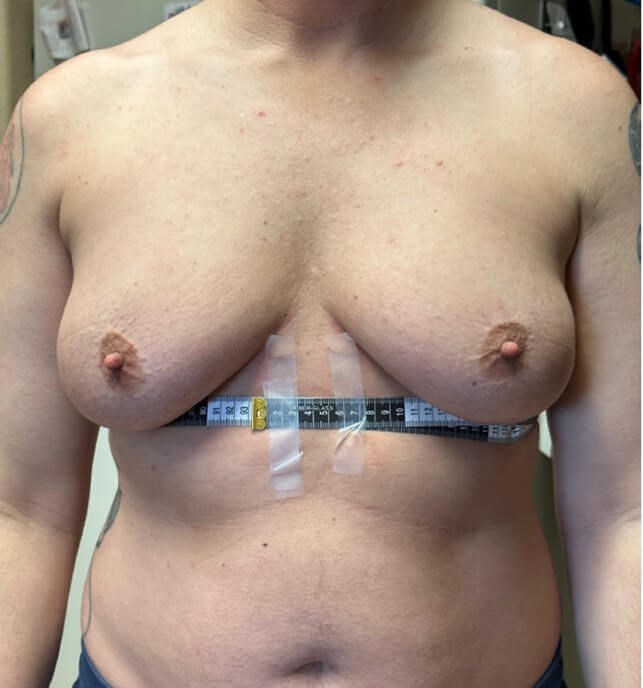 Mastectomy Surgery Before