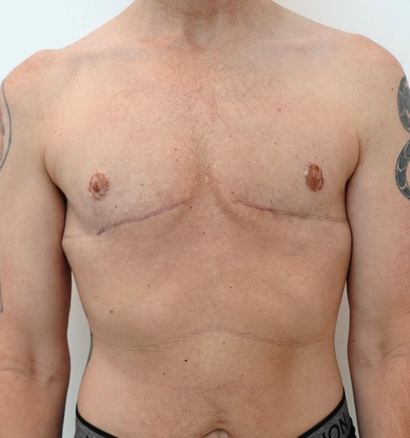 Mastectomy Surgery After